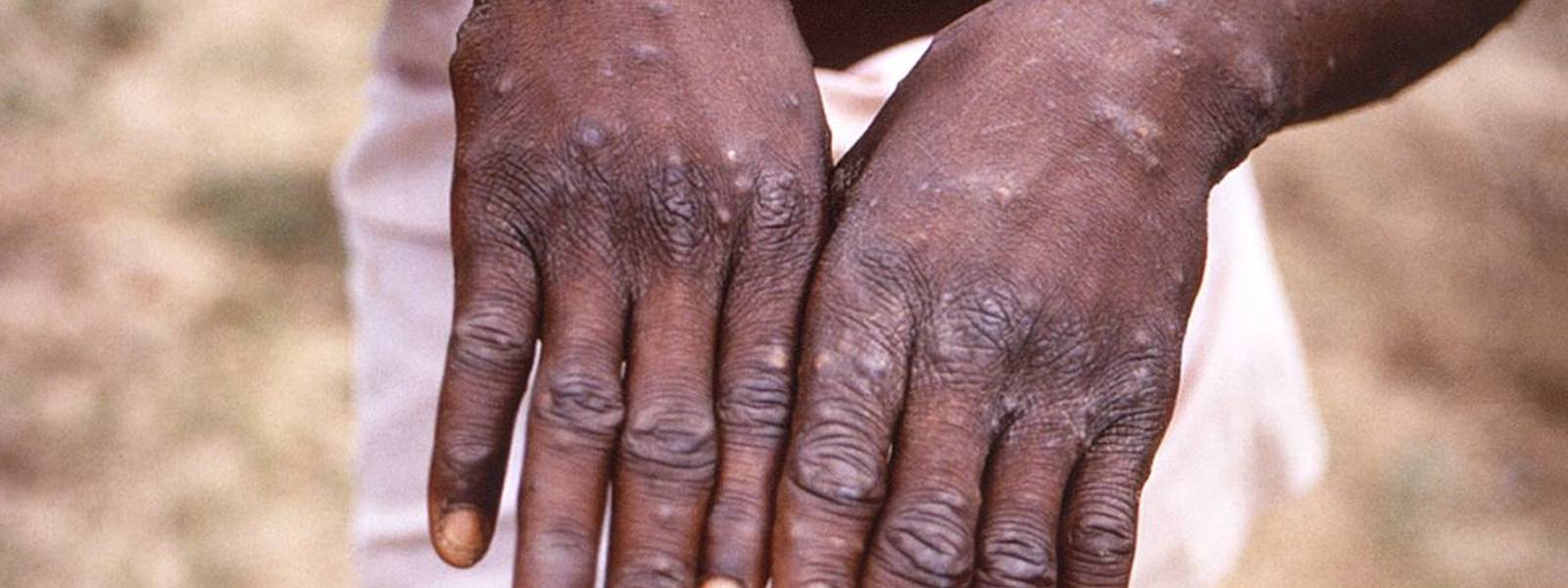 40 ஆண்டுகளின் பின்னர் பரவும் Monkeypox வைரஸ் 40 ஆண்டுகளின் பின்னர் பரவும் Monkeypox வைரஸ்