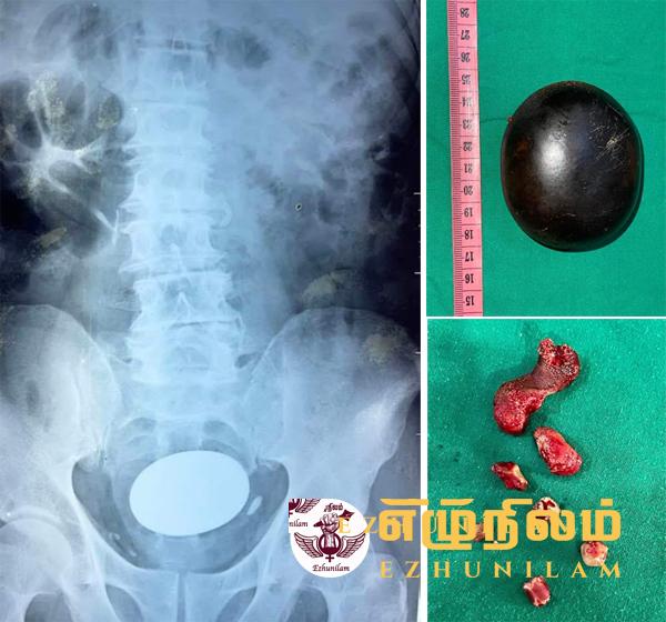 சிறுநீரகத்திலிருந்து மீட்கப்பட்ட விசித்திரமான கல்; கல்முனையில் வெற்றிகரமாக நிறைவடைந்த சத்திரசிகிச்சை சிறுநீரகத்திலிருந்து மீட்கப்பட்ட விசித்திரமான கல்; கல்முனையில் வெற்றிகரமாக நிறைவடைந்த சத்திரசிகிச்சை