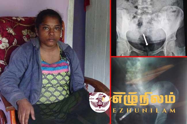 சவூதி சென்று வயிற்றில் ஆணியுடன் வந்த செல்வி!