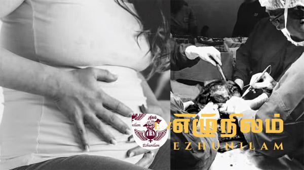 5 குழந்தைகளை போல் வயிற்றில் தோற்றமளித்த 15 கிலோ கட்டி